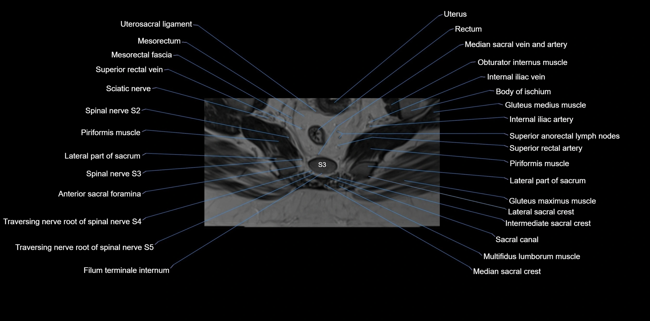 MRI sacrum, coccyx and sacroiliac joint axial cross sectional anatomy 3T  radiology  image-img-00001-00043.webp